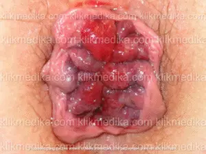 obat wasir