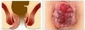 obat wasir